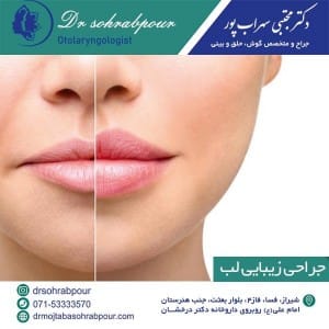 جراحی زیبایی لب