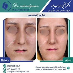 جراحی انحراف بینی