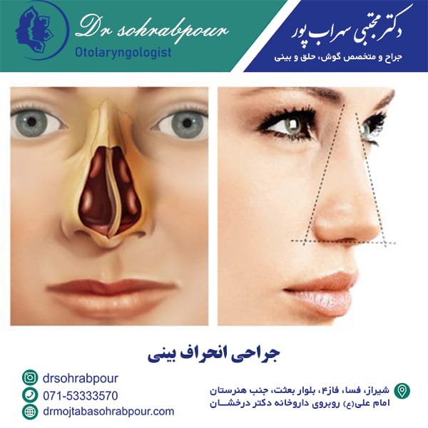 جراحی انحراف بینی