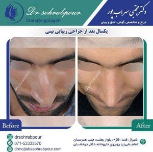 جراحی انحراف بینی