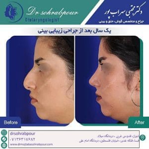 جراحی-بینی-طبیعی - دکتر مجتبی سهراب پور