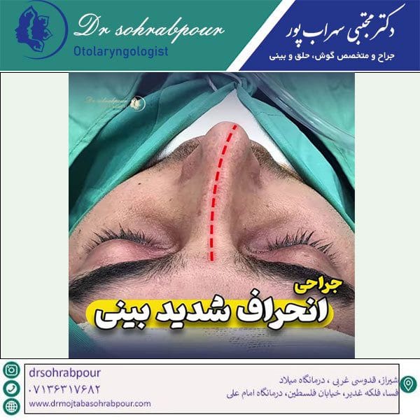 عکس جراحی بینی کج - دکتر مجتبی سهراب پور