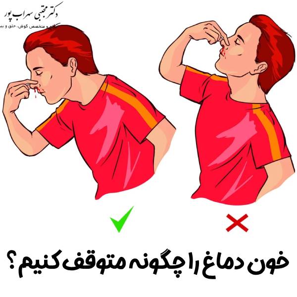 خون دماغ + علت و راه درمان