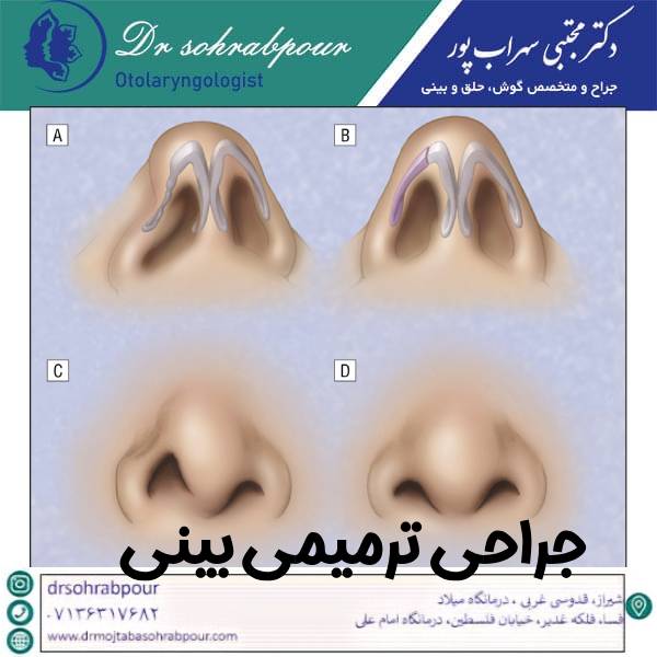 عکس جراحی ترمیمی بینی