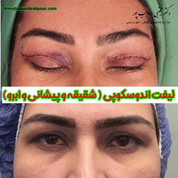 عکس نمونه کار لیفت اندوسکوپی - دکتر مجتبی سهراب پور