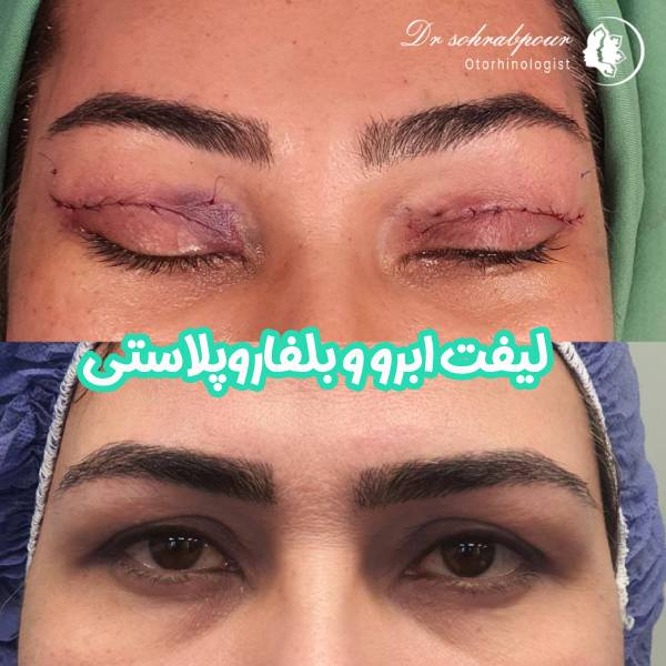 عکس لیفت ابرو و بلفاروپلاستی