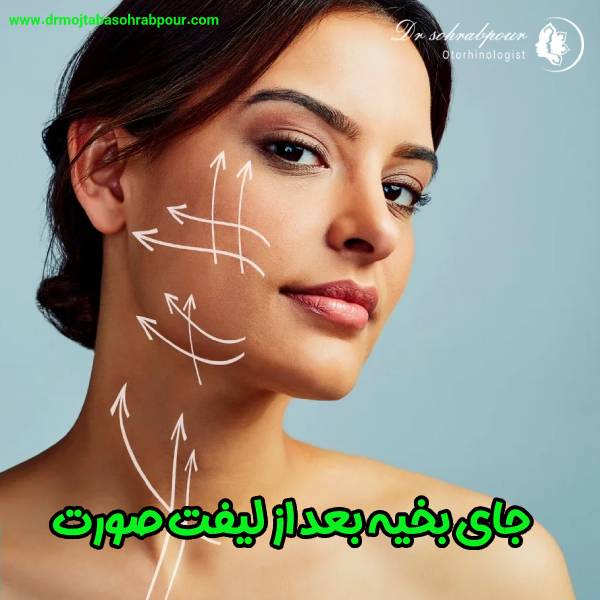 جای بخیه بعد از لیفت صورت