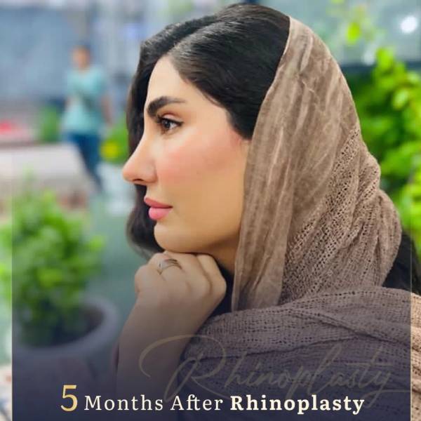 نمونه کار جراح بینی شیراز - دکتر مجتبی سهراب پور