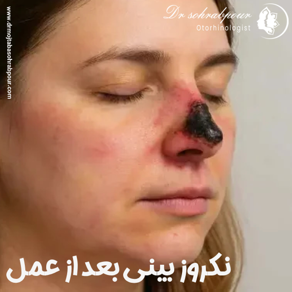 مشاهده وبررسی نکروز بینی بعد از جراحی بینی با دکتر مجتبی سهراب پور