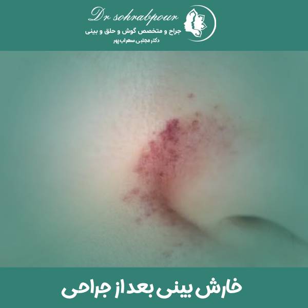 خارش بینی بعد از جراحی