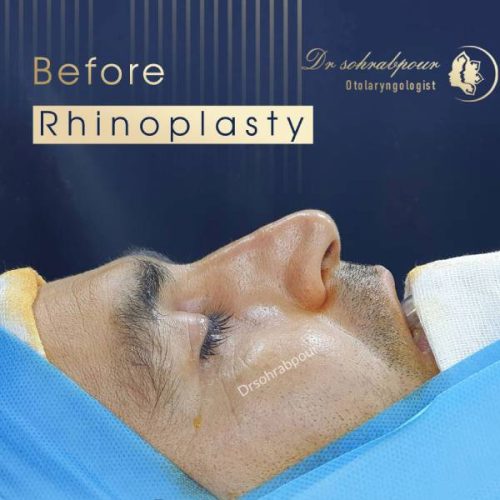 rhinoplasty-234 (1)