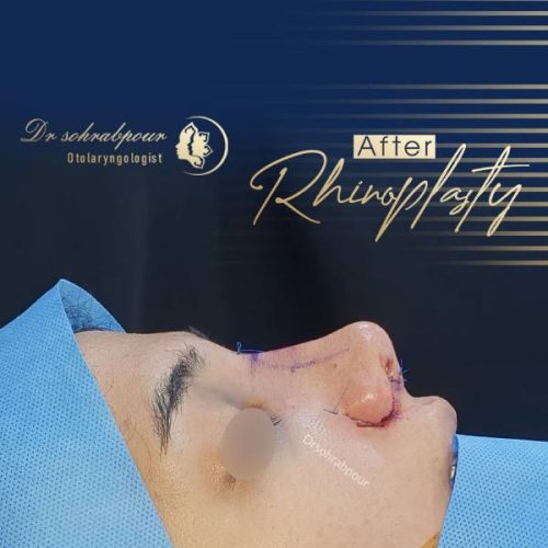 rhinoplasty-235