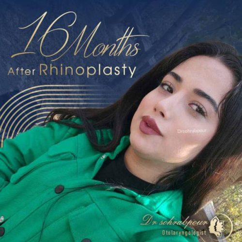 rhinoplasty-236