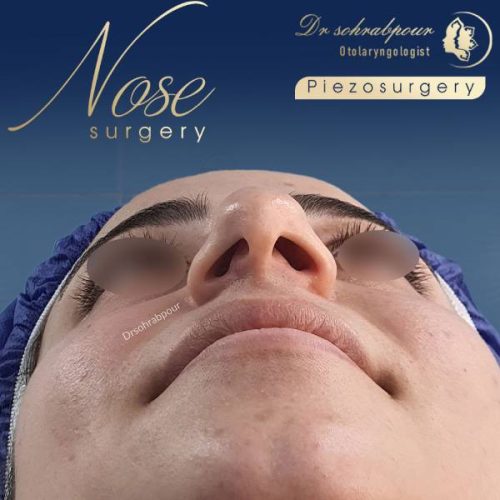rhinoplasty-237