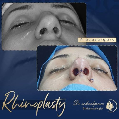 rhinoplasty-238