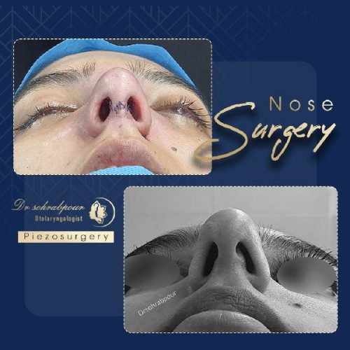rhinoplasty-239