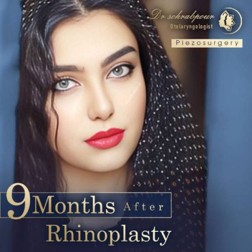rhinoplasty-244
