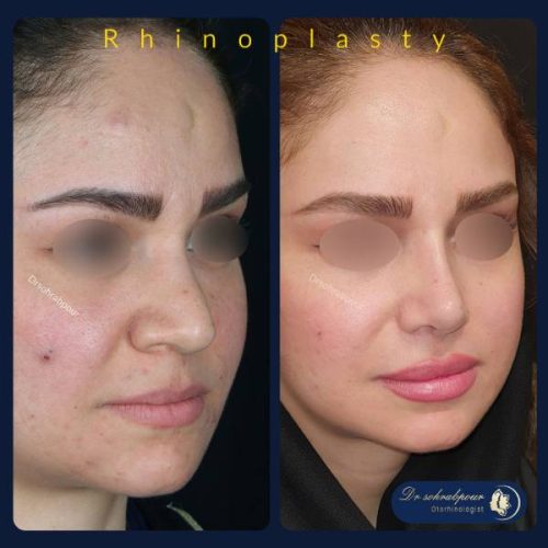 rhinoplasty-262