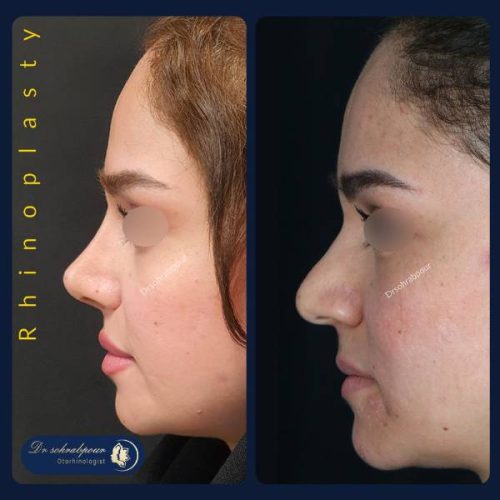 rhinoplasty-263