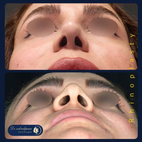 rhinoplasty-264