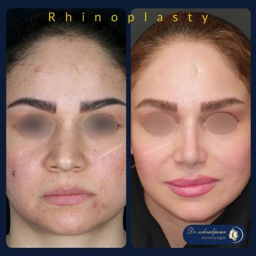 rhinoplasty-265
