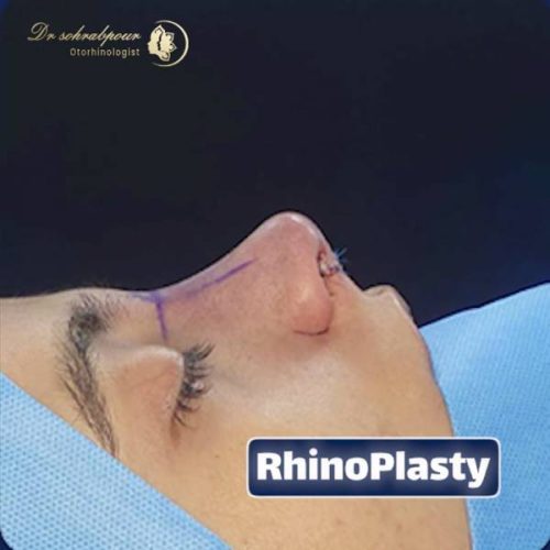 rhinoplasty-266