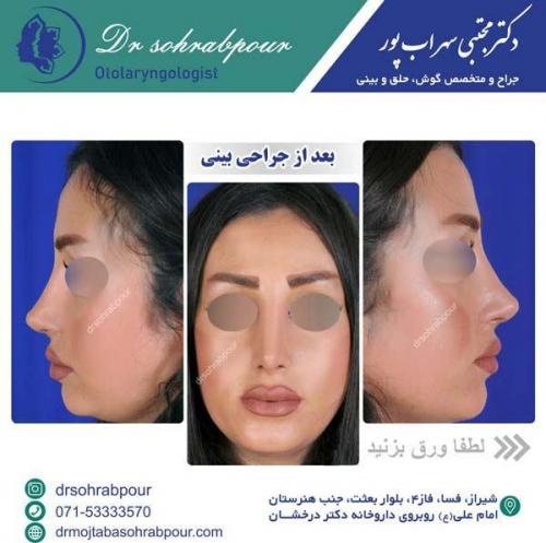 بعد-از-جراحی-بینی-2