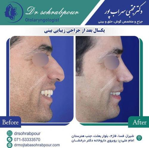 جراحی-بینی-100
