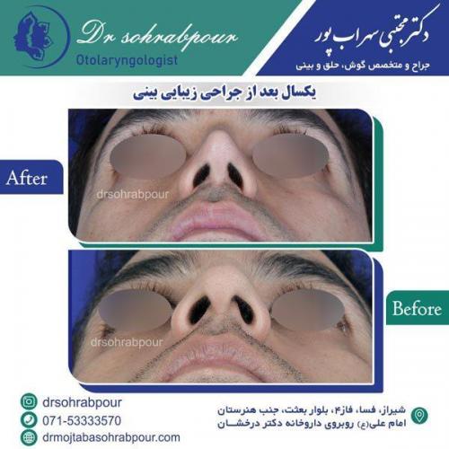جراحی-بینی-101