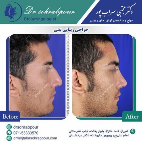 جراحی-بینی-11