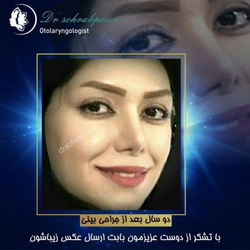 جراحی-بینی-119