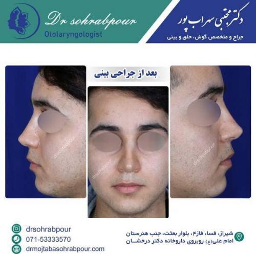 جراحی-بینی-131