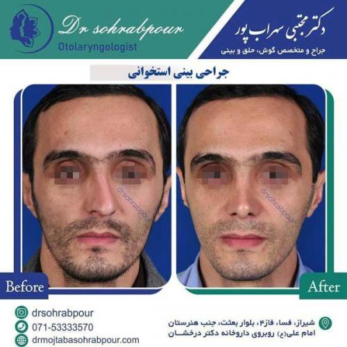 جراحی-بینی-132