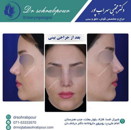 جراحی-بینی-133
