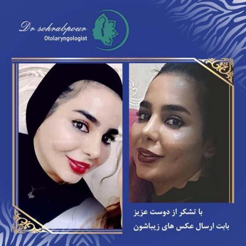 جراحی-بینی-134