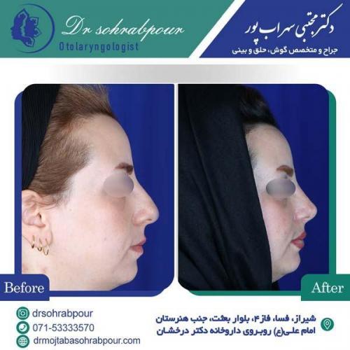 جراحی-بینی-136