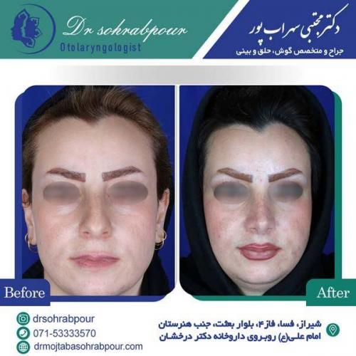 جراحی-بینی-137