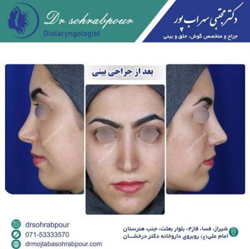 جراحی-بینی-138