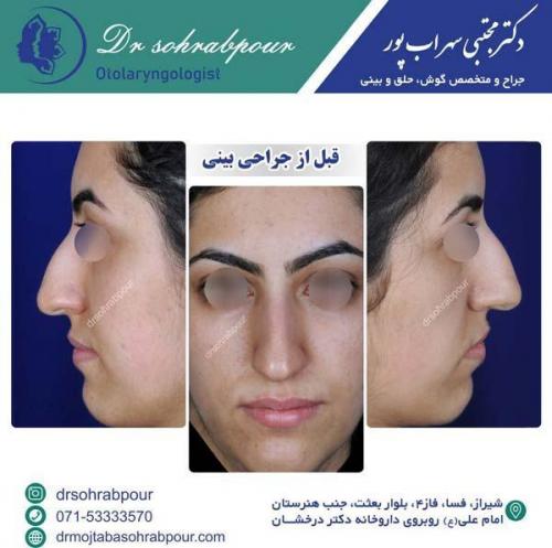 جراحی-بینی-139