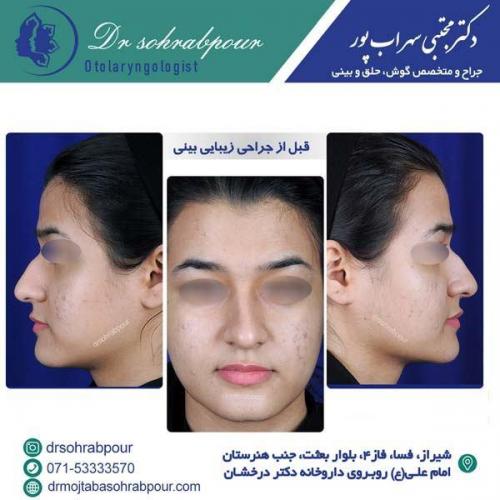 جراحی-بینی-140