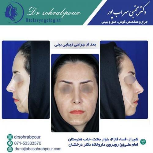 جراحی-بینی-146