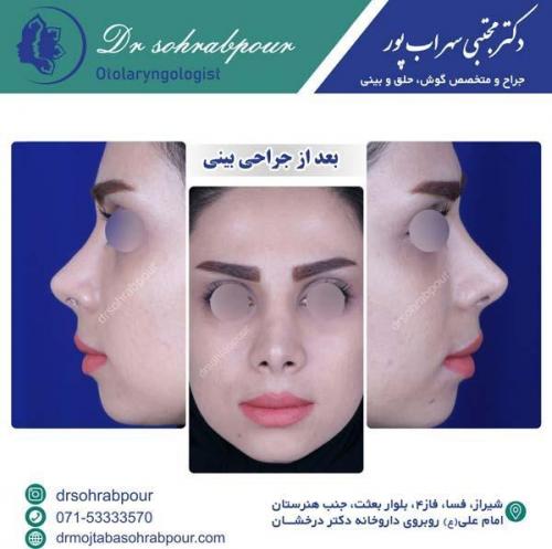 جراحی-بینی-147