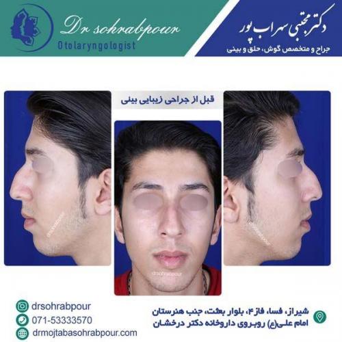 جراحی-بینی-151