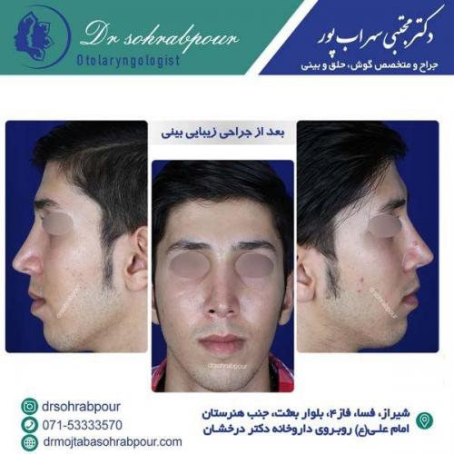 جراحی-بینی-152