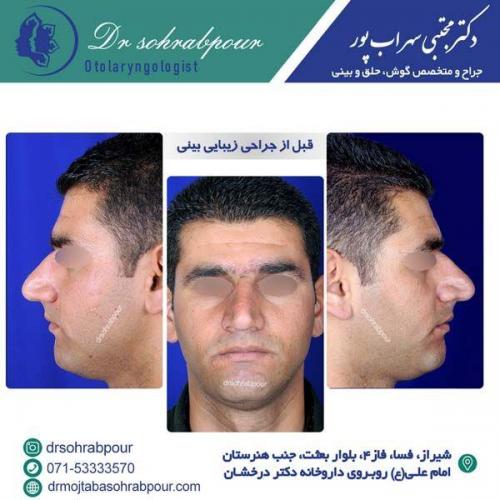 جراحی-بینی-153