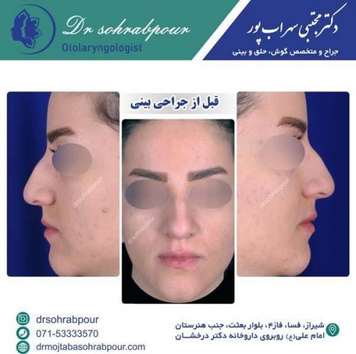 جراحی-بینی-154