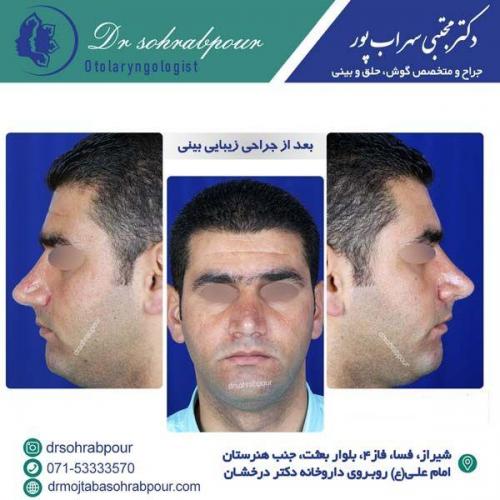 جراحی-بینی-155