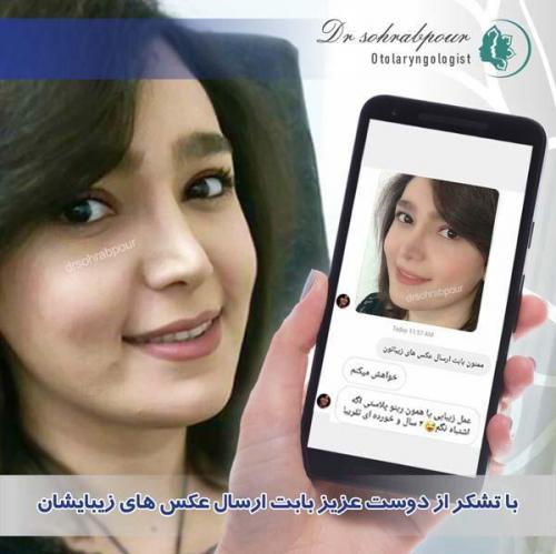 جراحی-بینی-156