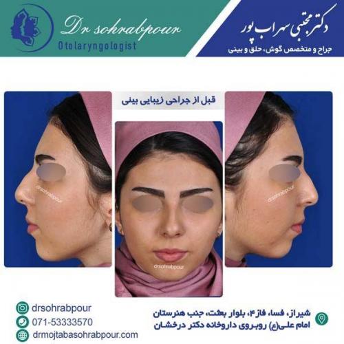 جراحی-بینی-157