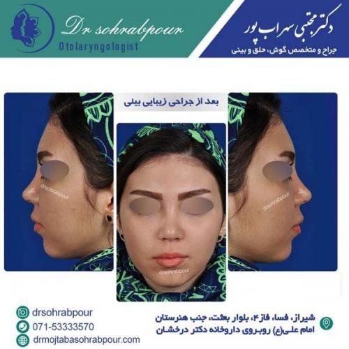 جراحی-بینی-158